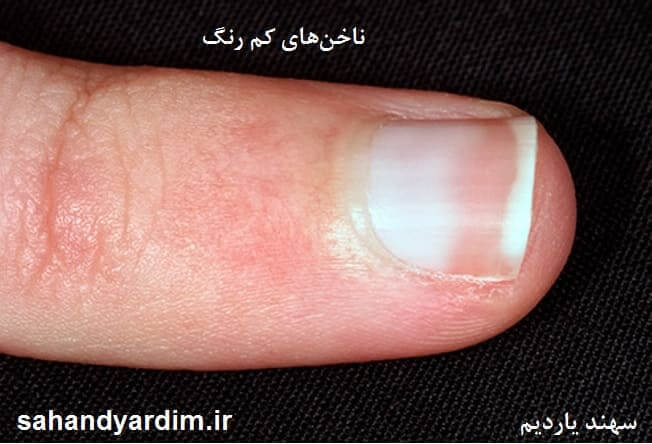ناخن‌های کم رنگ با لکه های سفید یا لوکونیشیا نشانه چه بیماری هایی است ؟